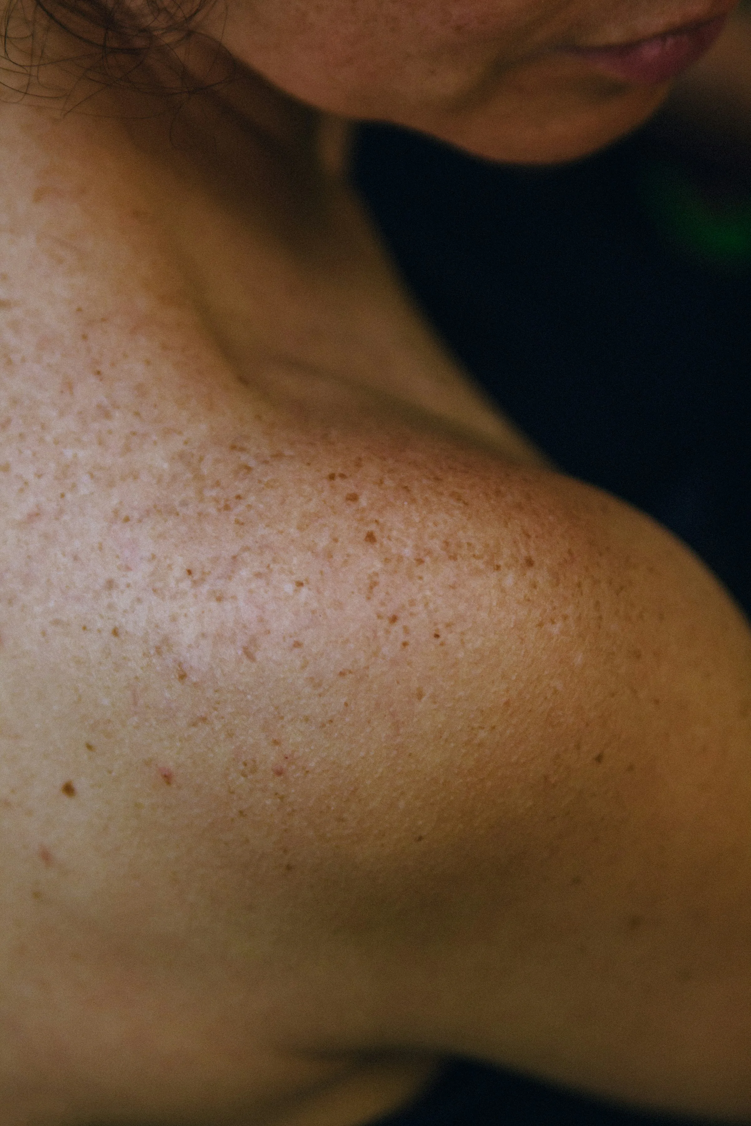 A freckled shoulder in the sun